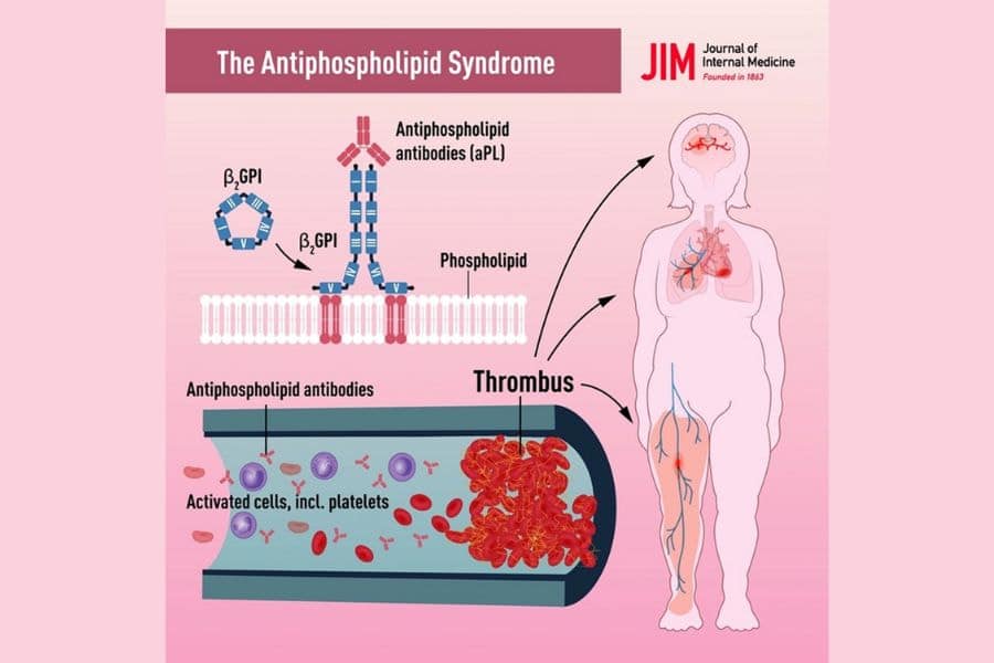 antiphospholipid là gì